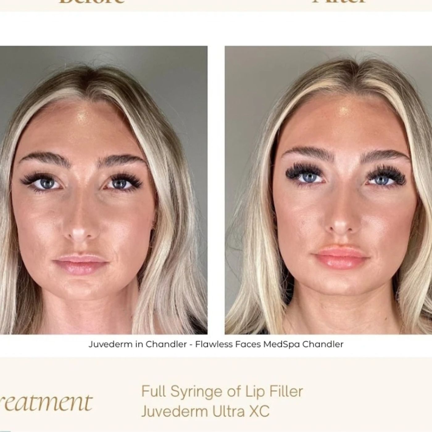 Flawless Faces Med Spa Chandler | Botox, Lip Fillers And Laser Hair Removal