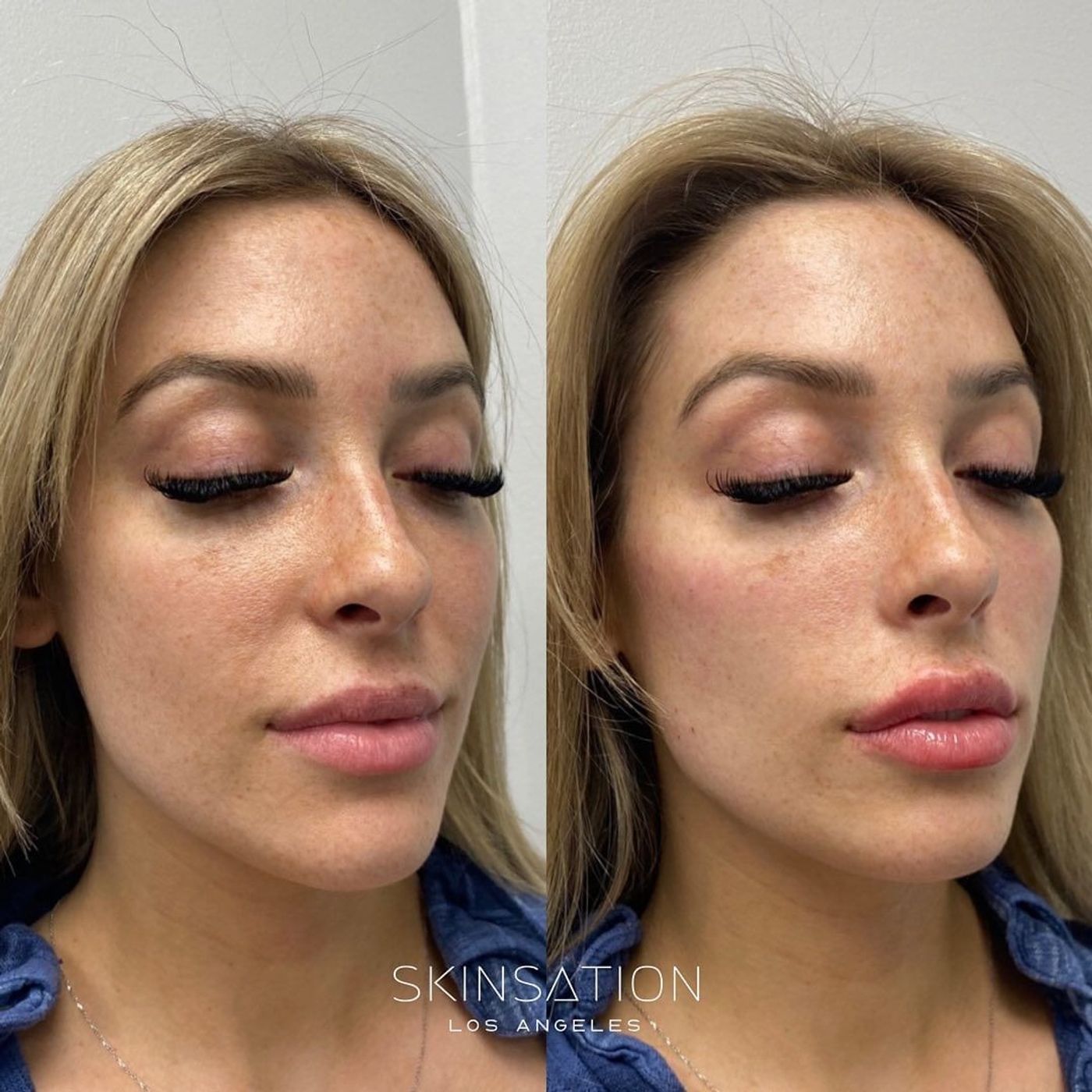 Skin Tightening, Botox and Lip Fillers by Skinsation LA