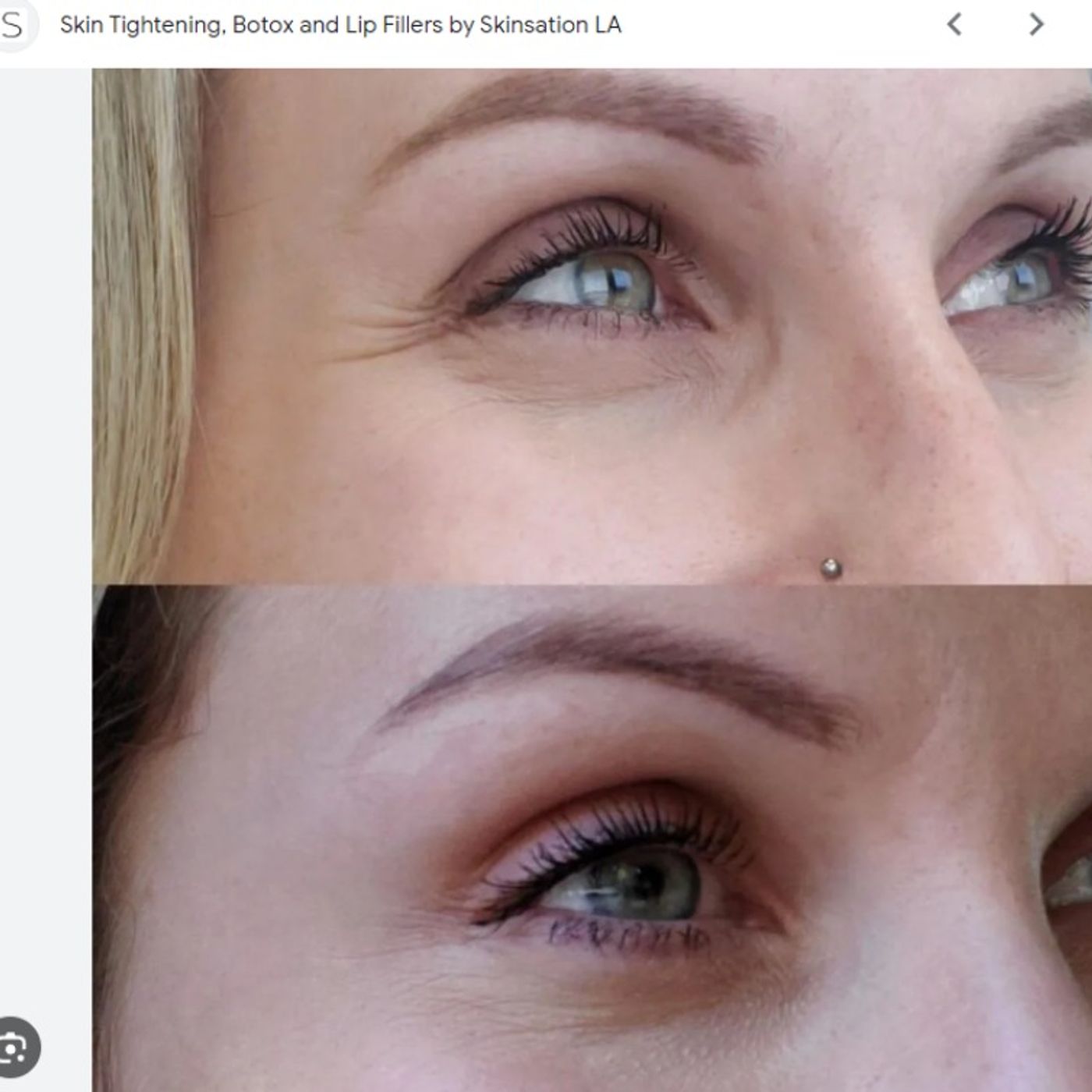 Skin Tightening, Botox and Lip Fillers by Skinsation LA