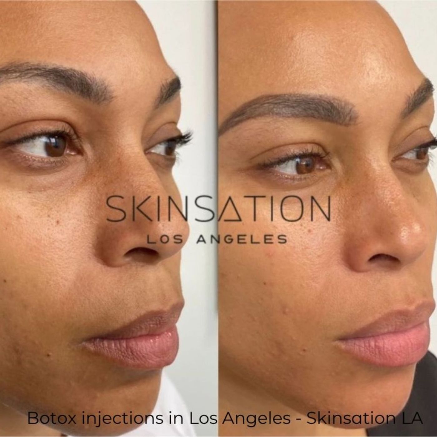 Skin Tightening, Botox and Lip Fillers by Skinsation LA