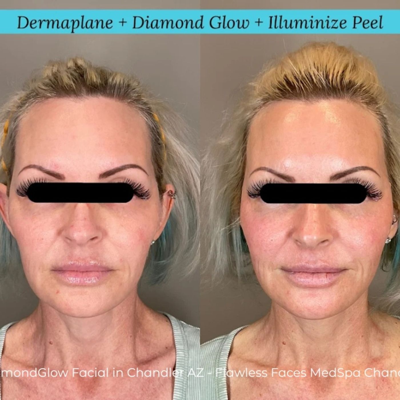 Flawless Faces Med Spa Chandler | Botox, Lip Fillers And Laser Hair Removal
