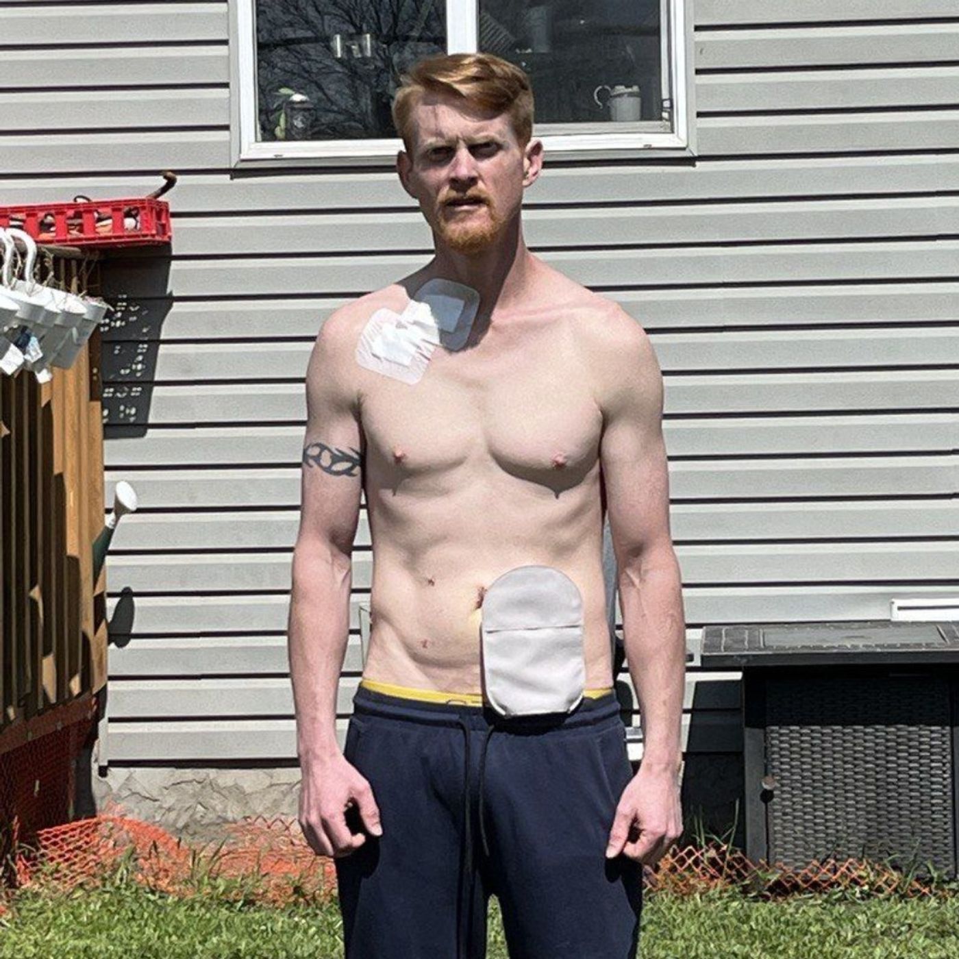 Episode 460: How Cannabis Helped Brenton Crow Overcome Stage 3B Rectal Cancer