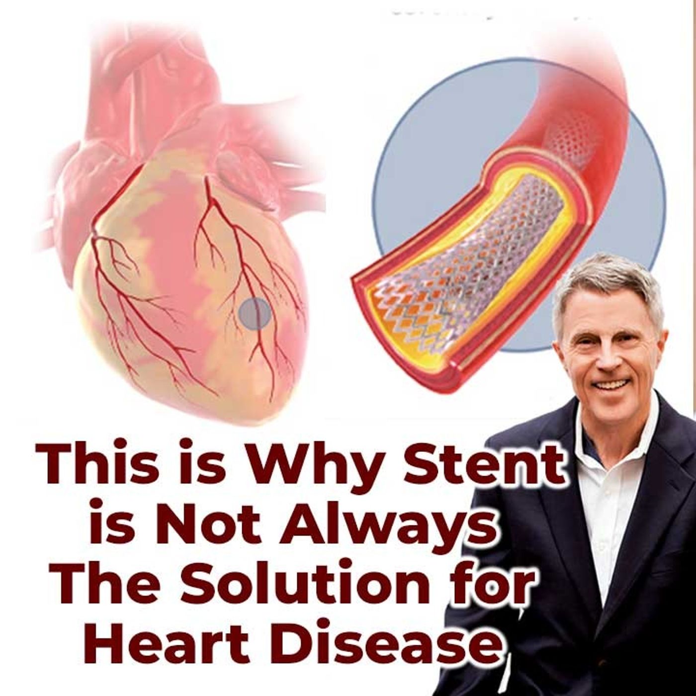 This is Why Stent is Not Always The Solution for Heart Disease  - FORD BREWER MD MPH