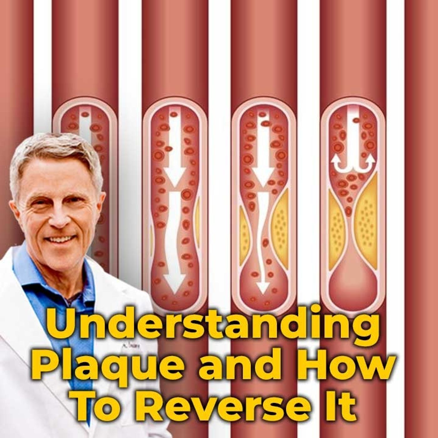 Understanding Plaque and how to reverse it - FORD BREWER MD MPH