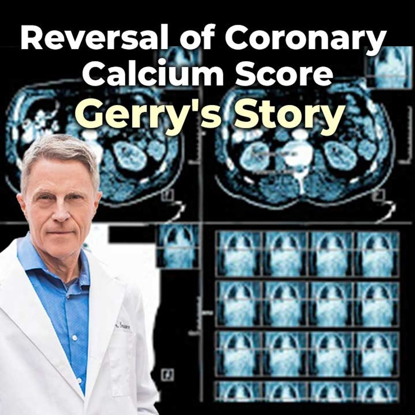 Reversal of Coronary Calcium Score: Gerry's Story - FORD BREWER MD MPH