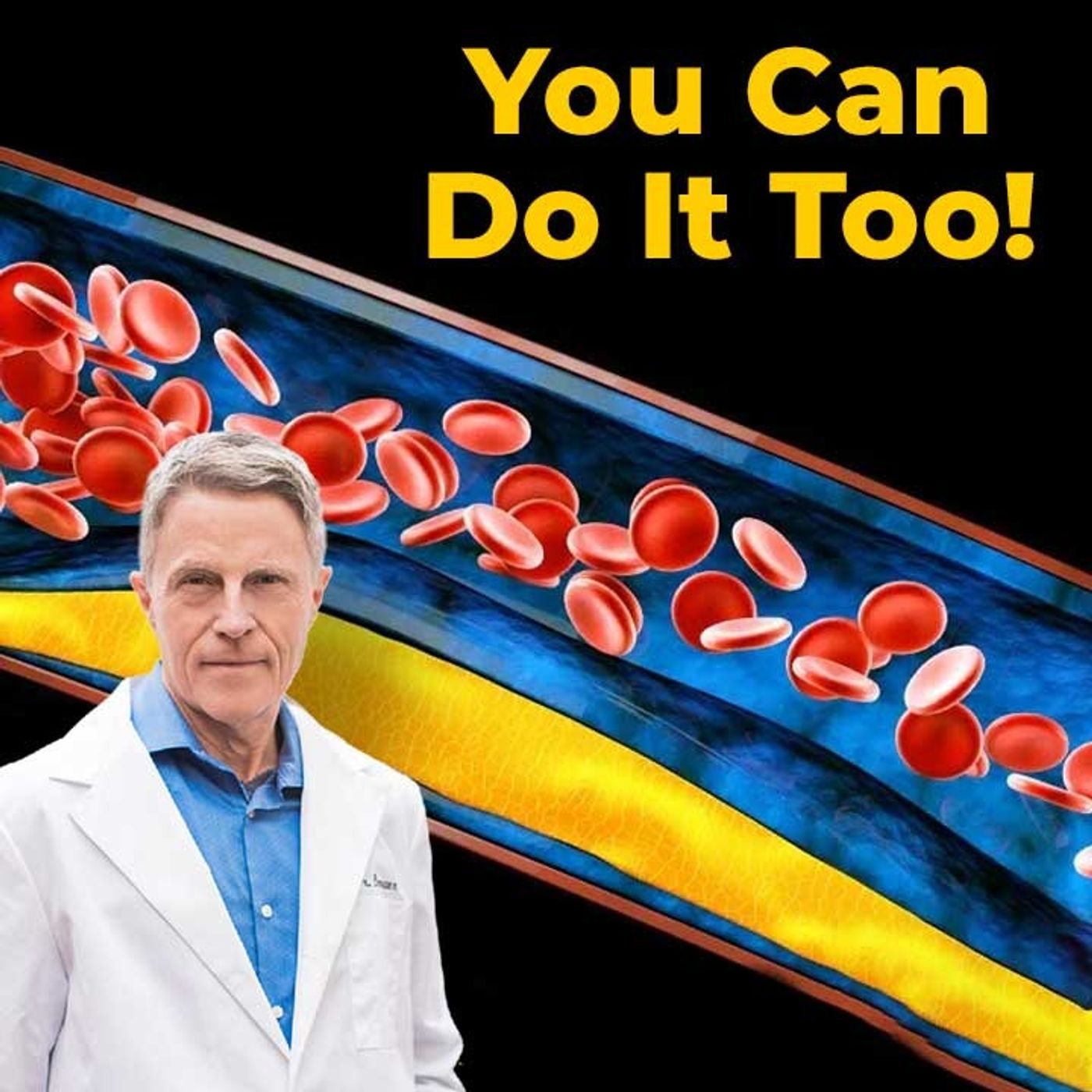 Did I Reverse My CV Plaque? Yes. Here's What Happened - FORD BREWER MD MPH