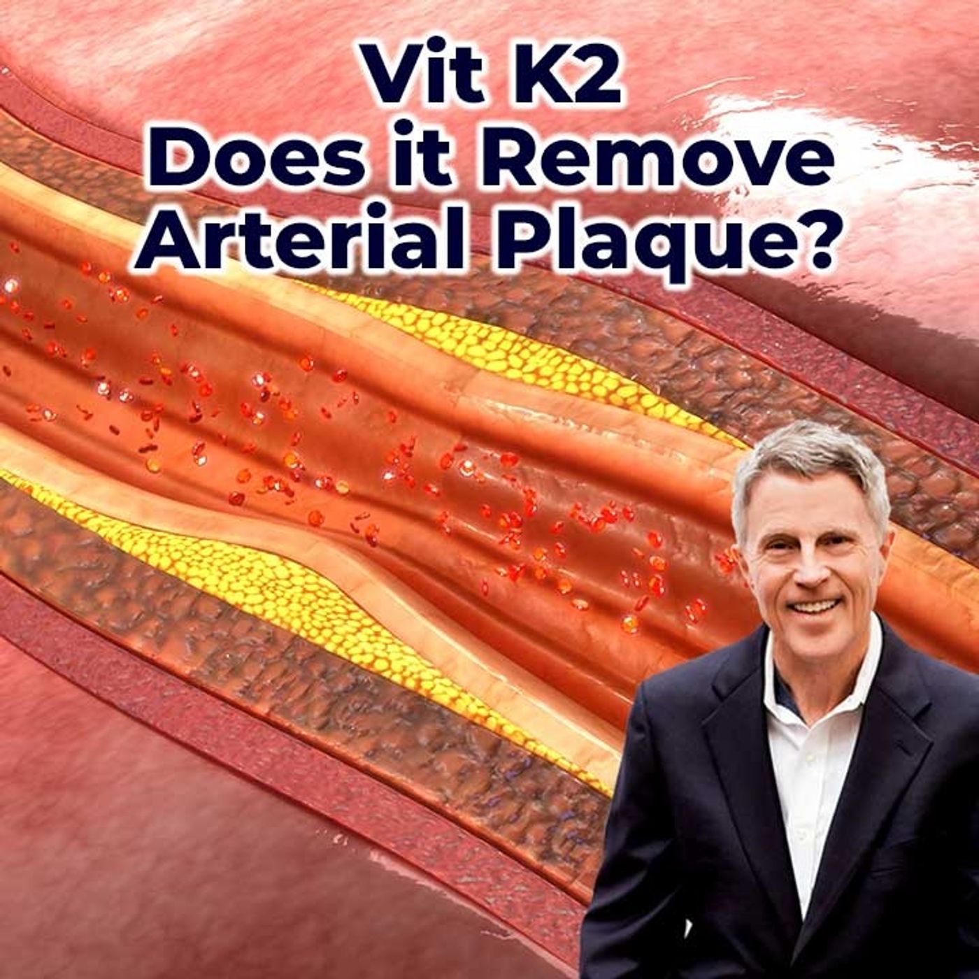 Vit K2 - Does it Remove Arterial Plaque? - FORD BREWER MD MPH