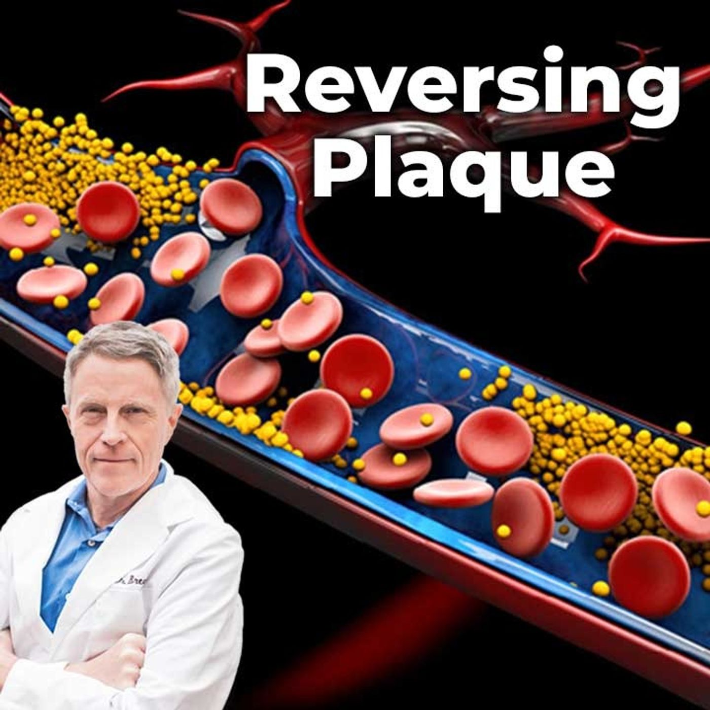 Plaque Reversal from a Patient's Experience - FORD BREWER MD MPH