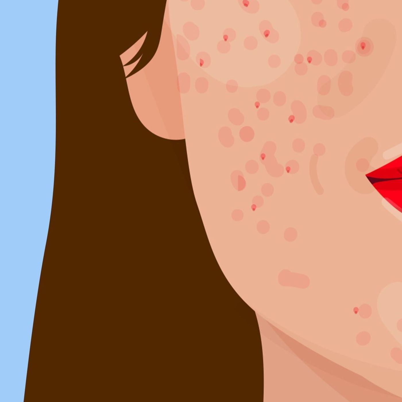 Acne episode artwork