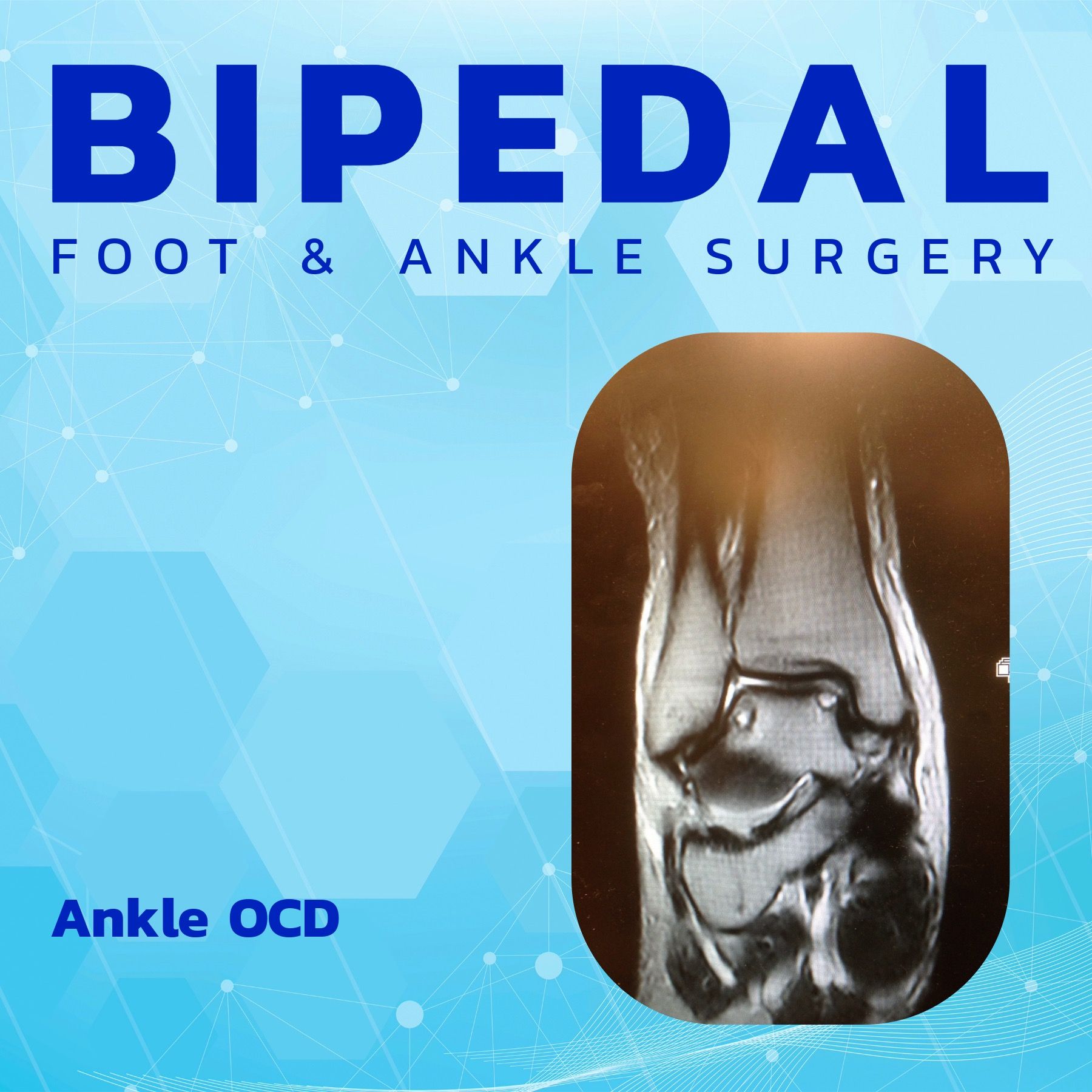 Ankle OCD episode artwork