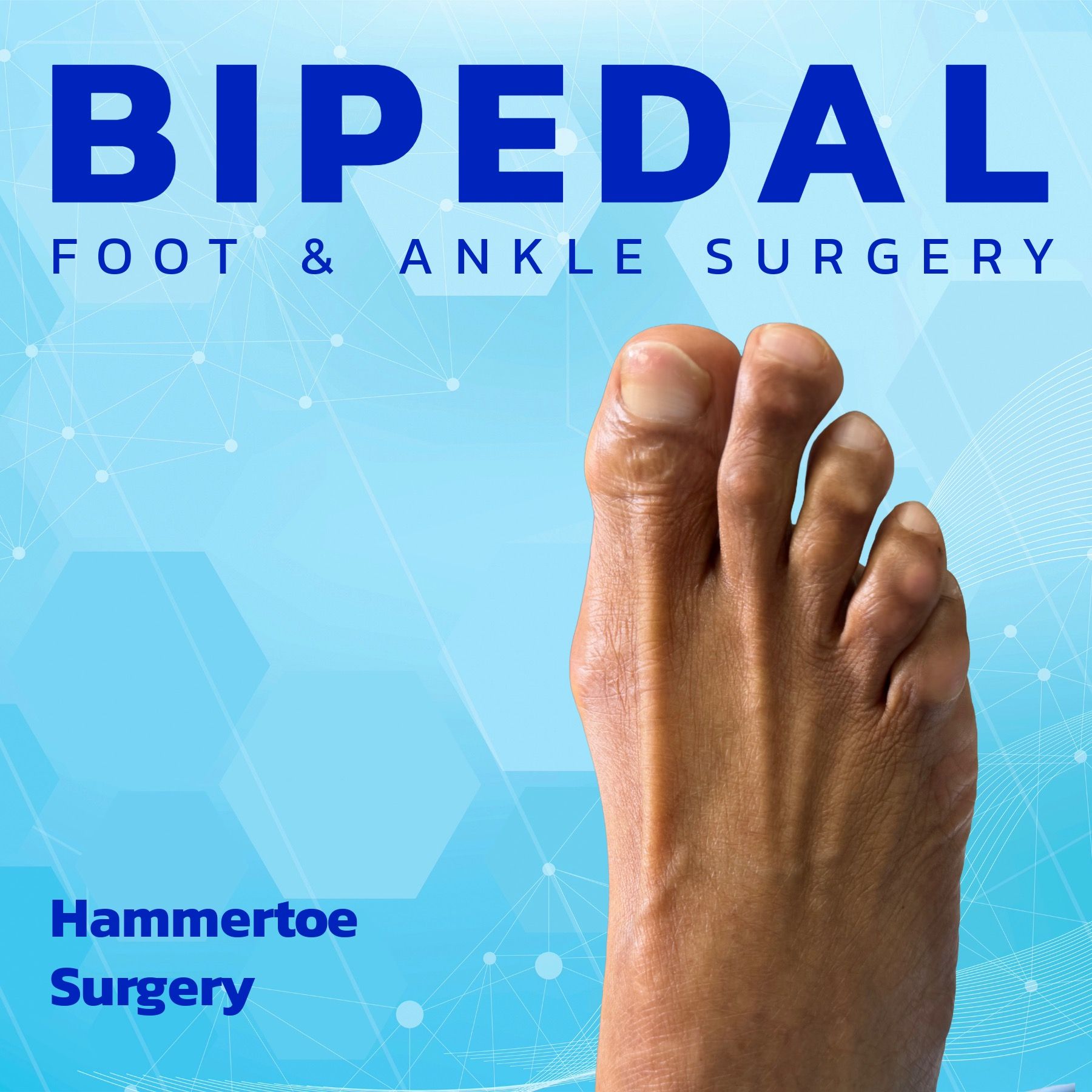 Hammertoe Surgery episode artwork