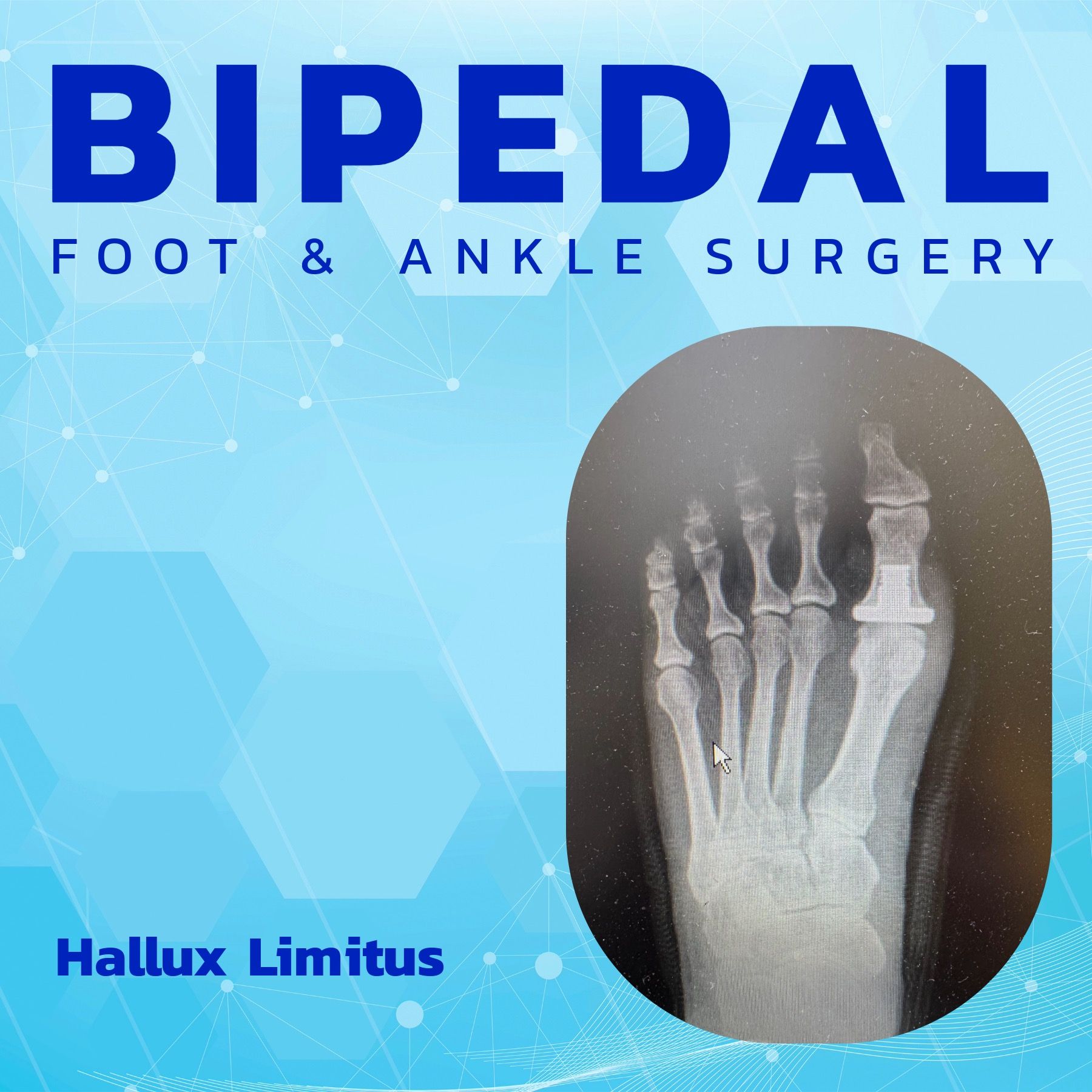 Hallux Limitus Surgery episode artwork