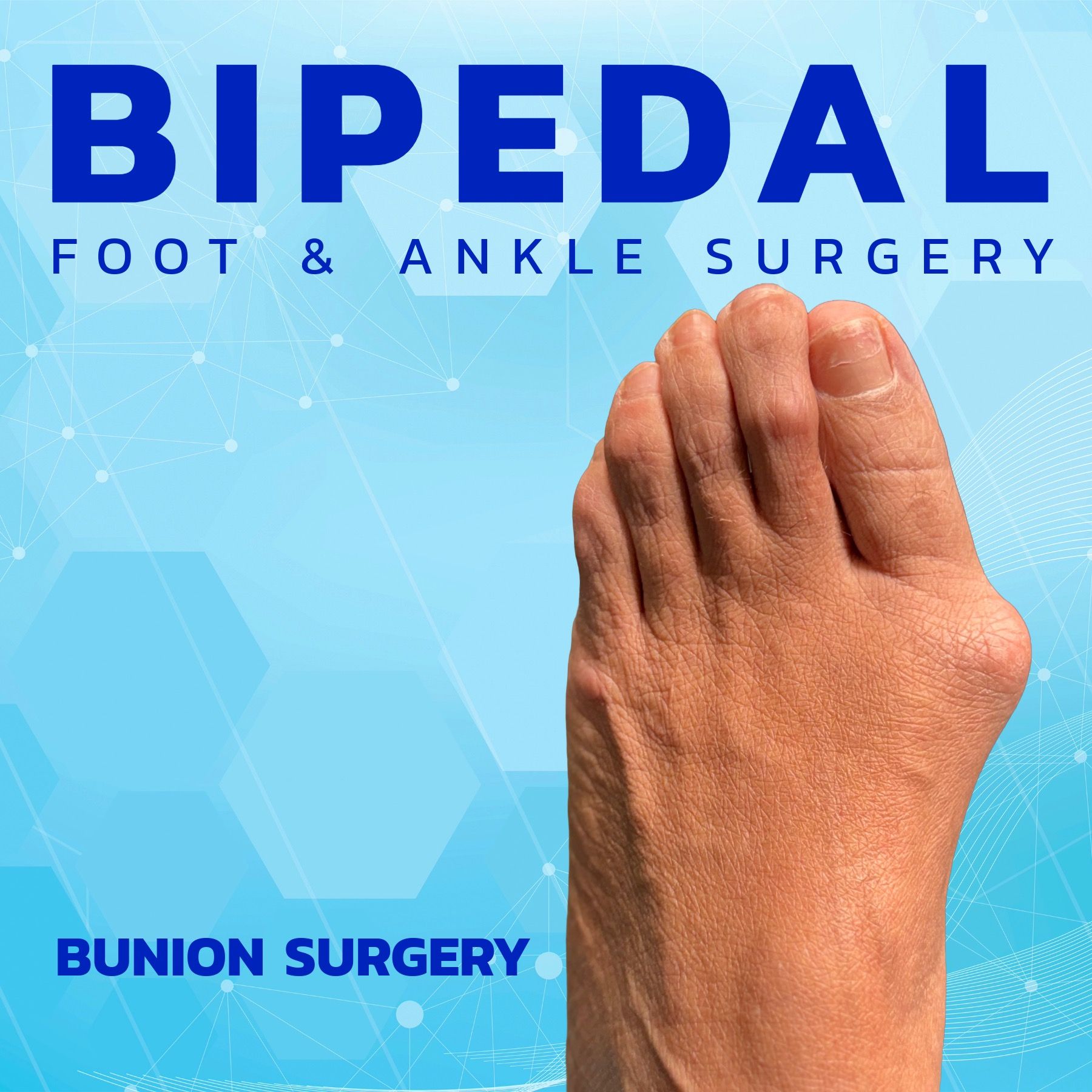 Bunion Surgery
