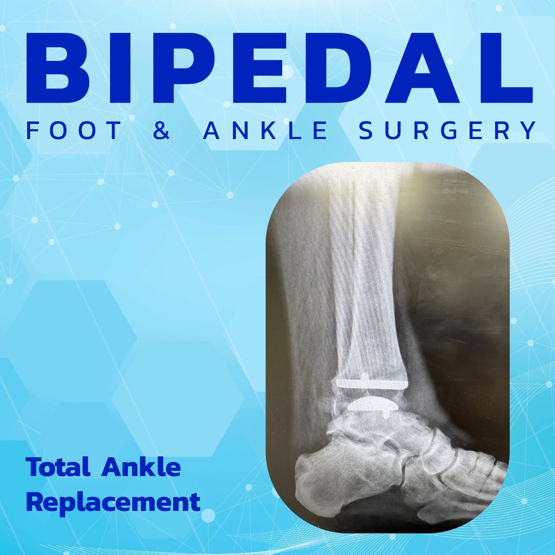 Total Ankle Replacement episode artwork