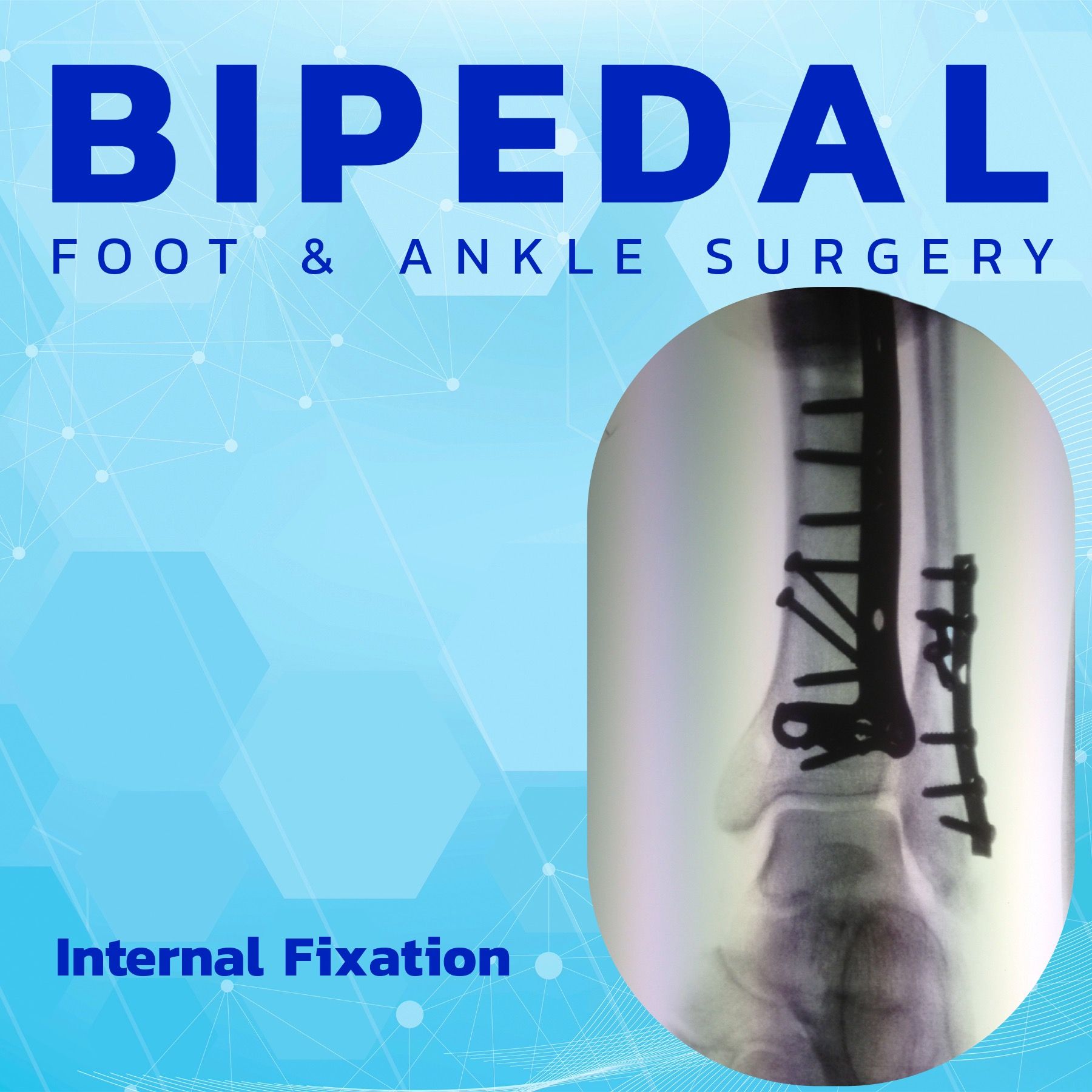 Internal Fixation Part 2 - Fracture Biomechanics episode artwork