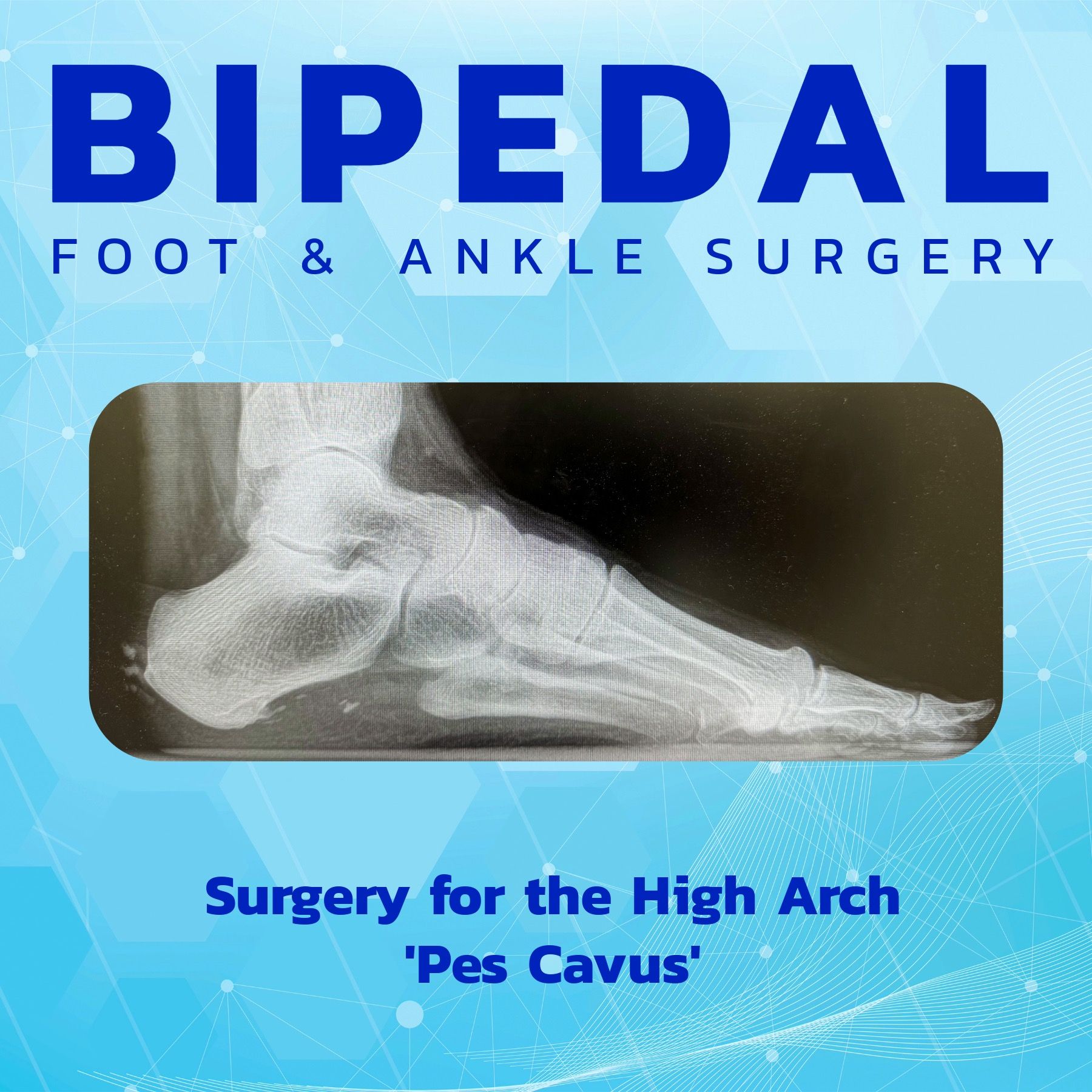 Surgery for the High Arch - Pes Cavus episode artwork