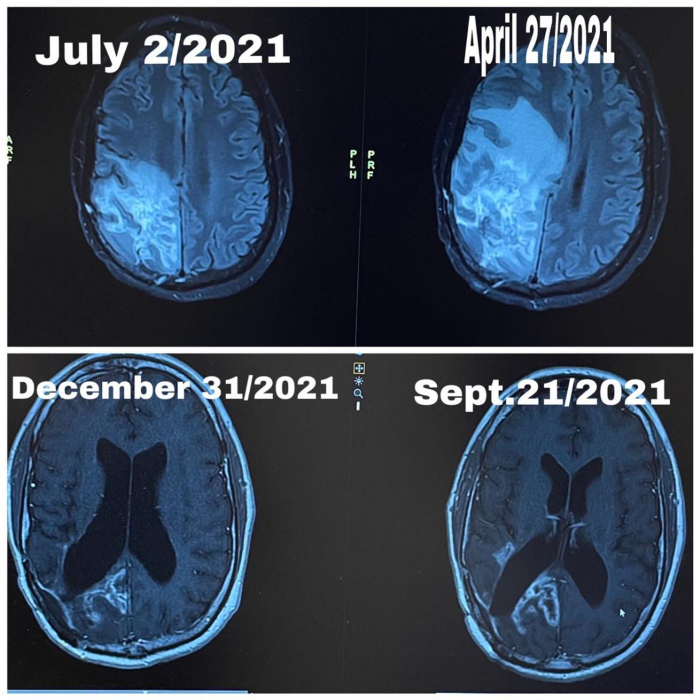 Episode 331: His Brain Tumor is Rapidly Shrinking Three Years After Fatal Diagnosis